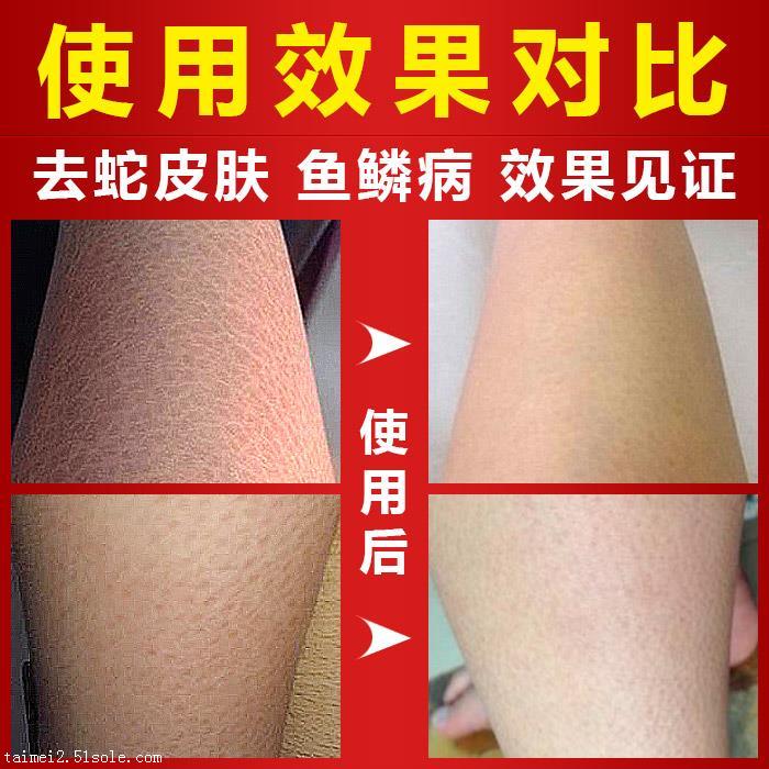 哈西奈德乳膏可以去鸡皮肤(哈西奈德乳膏可以涂抹阴囊吗)